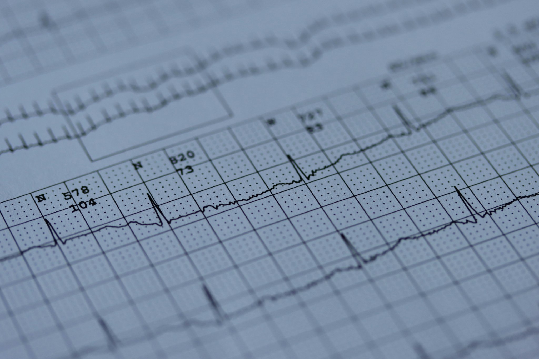 EKG-Ausdruck: Herzrhythmus-Kurve auf Millimeterpapier